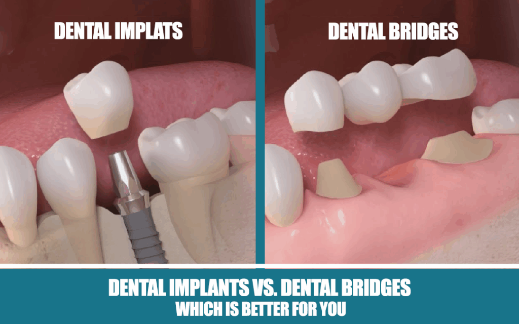 Affordable dental implants in Ontario