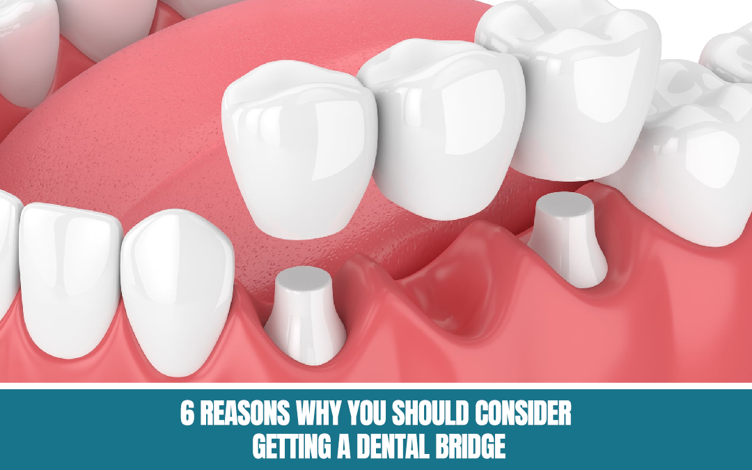 Dental Bridge