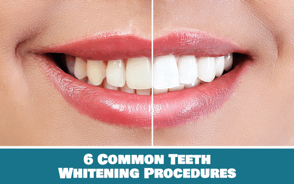 Teeth Whitening Procedures