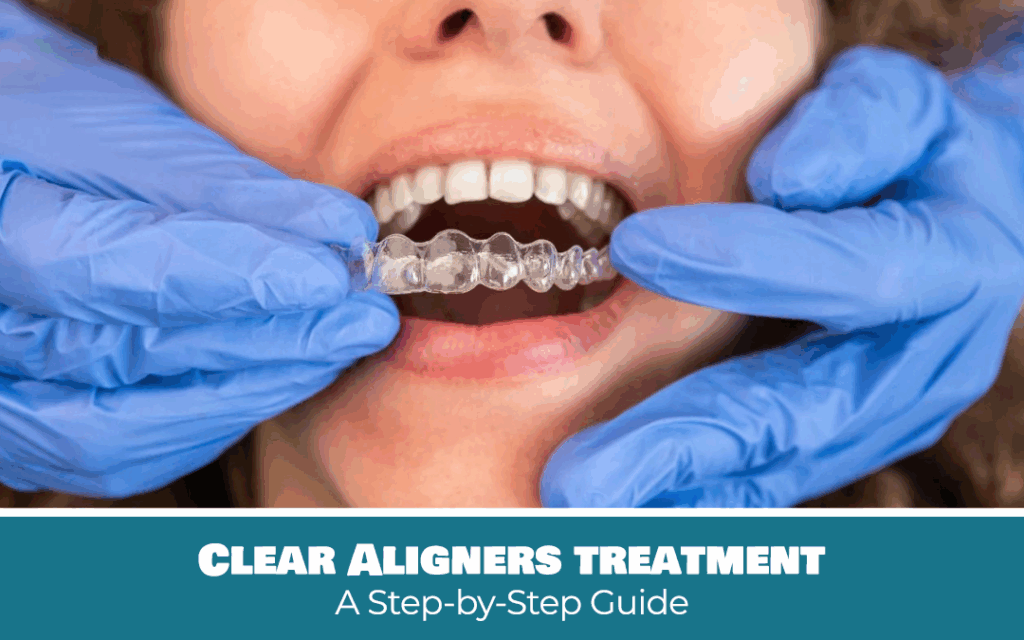 Clear aligners