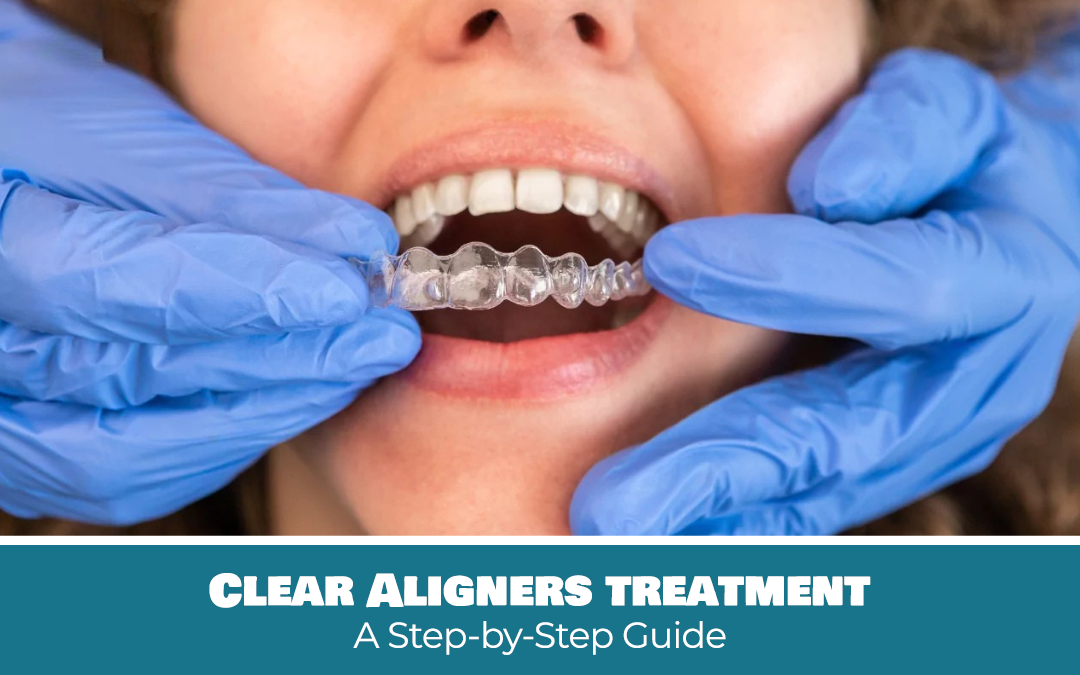 Clear aligners