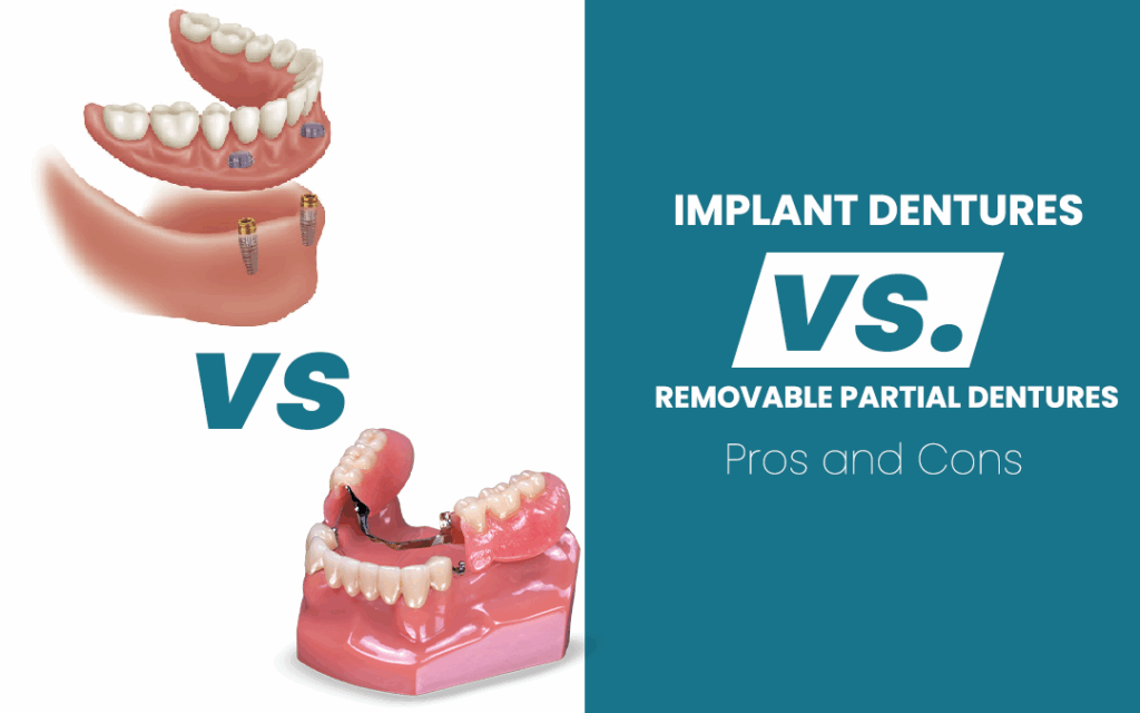 Implant dentures and removable partial dentures