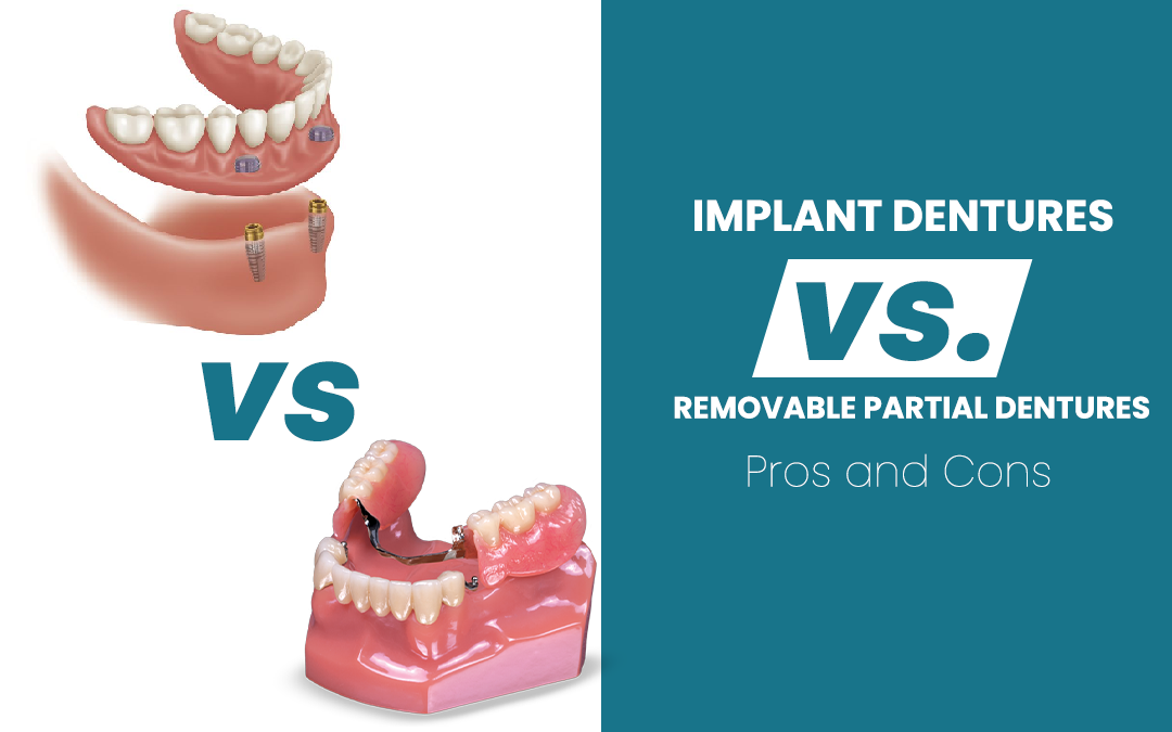Implant dentures and removable partial dentures