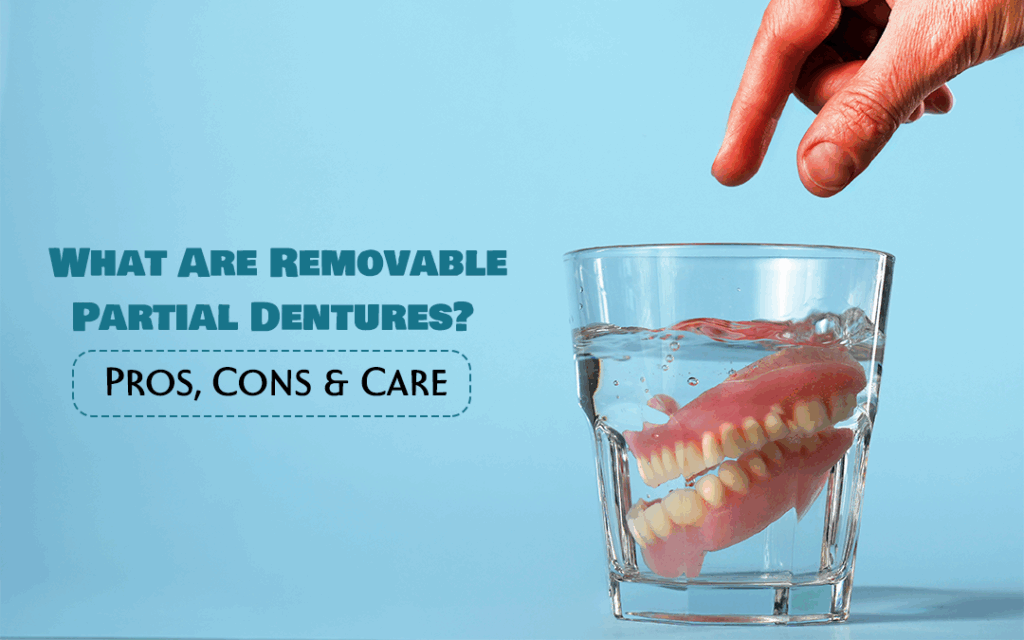 Removable partial dentures