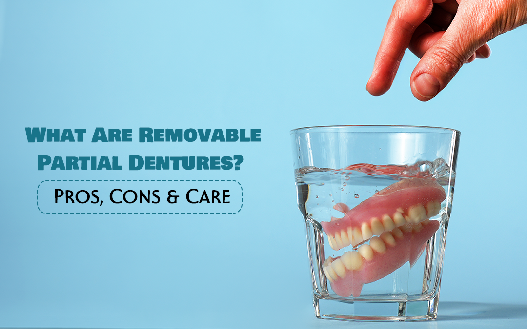 Removable partial dentures