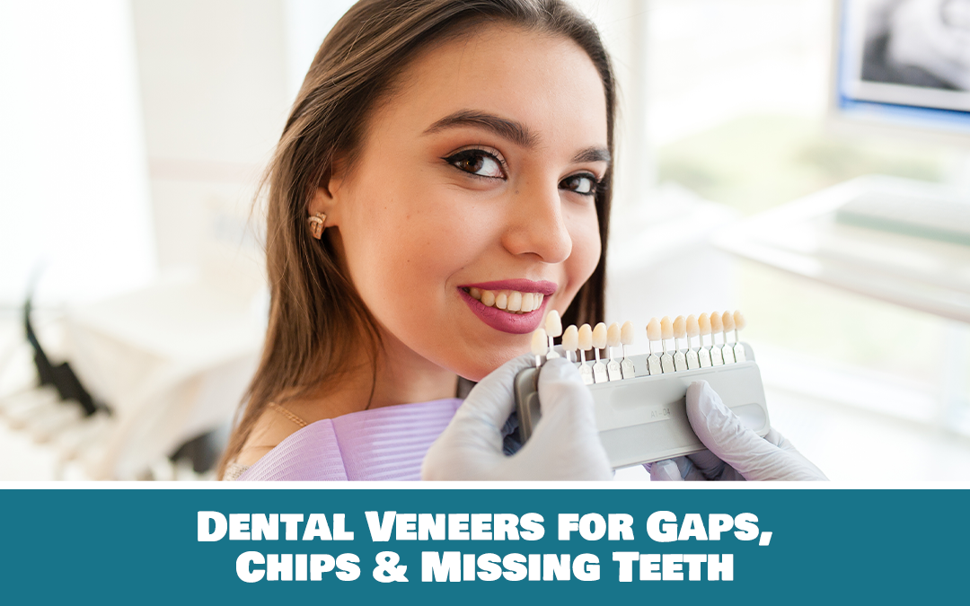 Veneers for missing teeth
