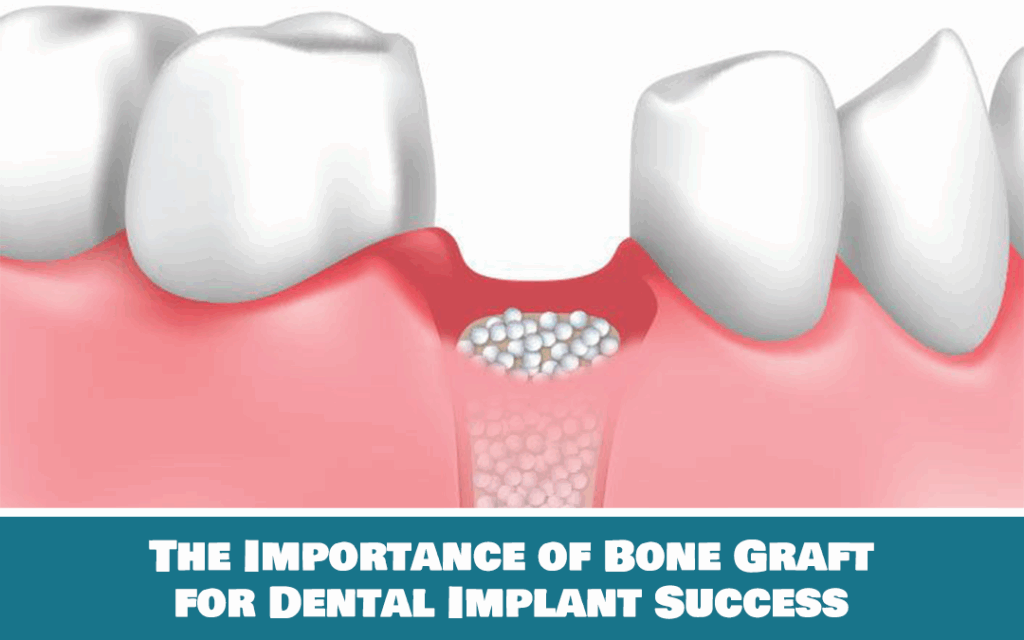 bone graft for dental implant