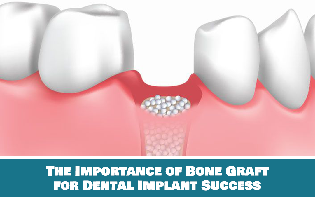 bone graft for dental implant